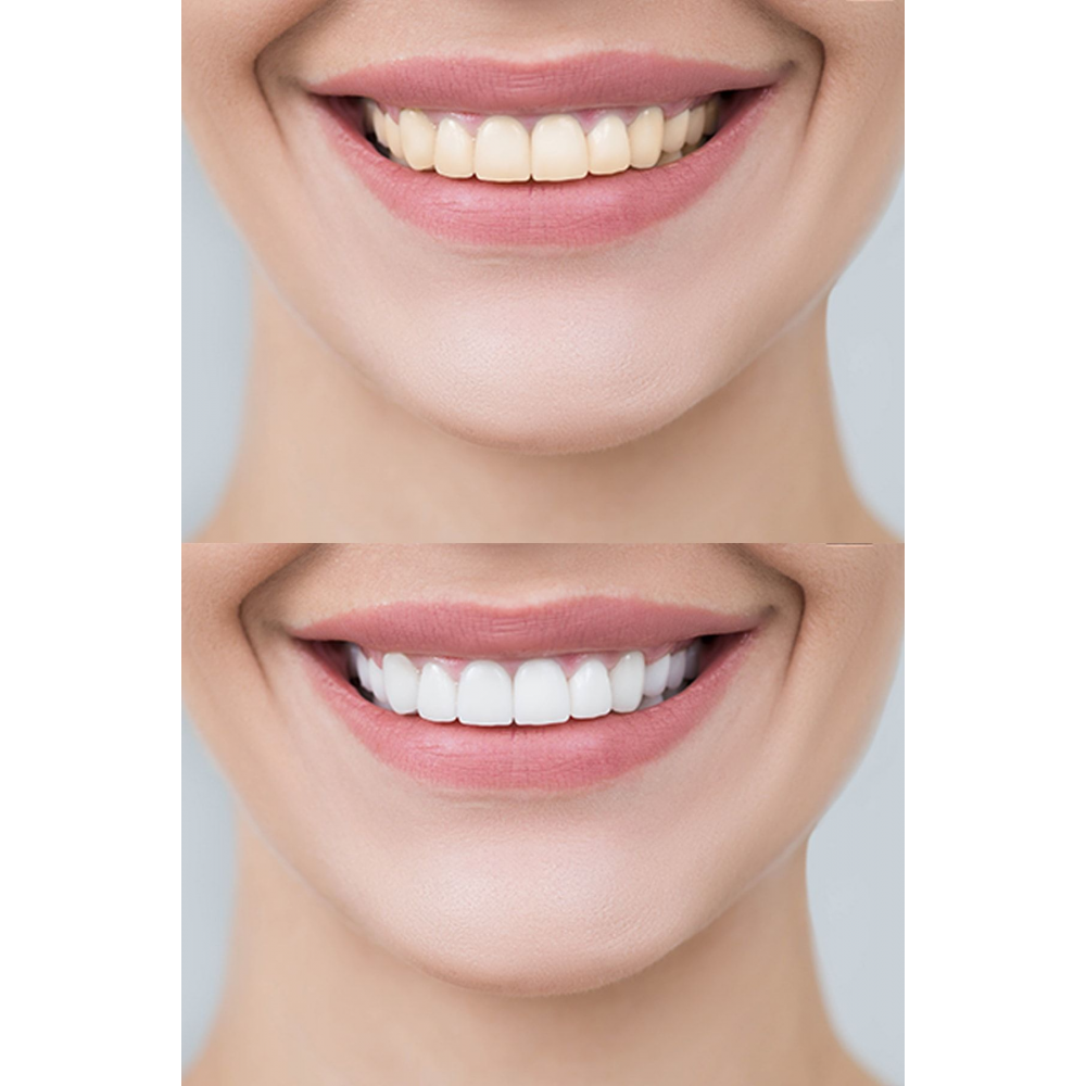 Diş Beyazlatma Seti (Diş macunu 75ml + Toz 50gr)