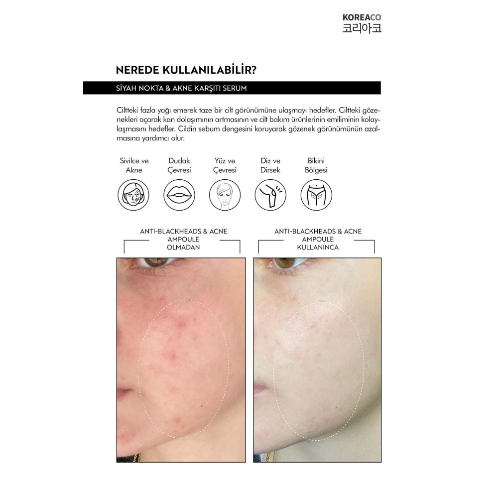 Anti-Blackheads Acne Ampoule Siyah Nokta ve Akne Ampulü
