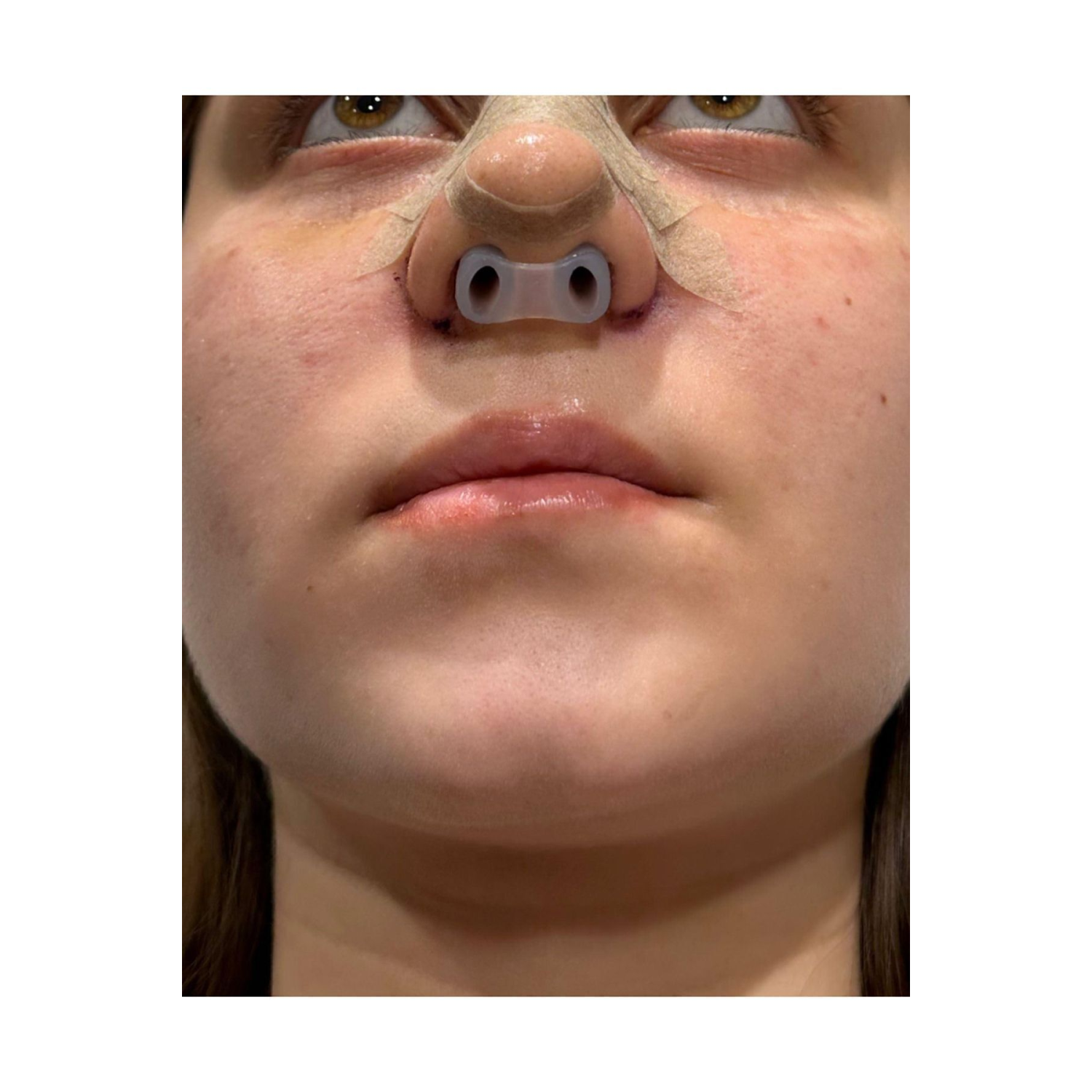 Burun Deliği Şekillendirici(1)(7)nostril Retainer