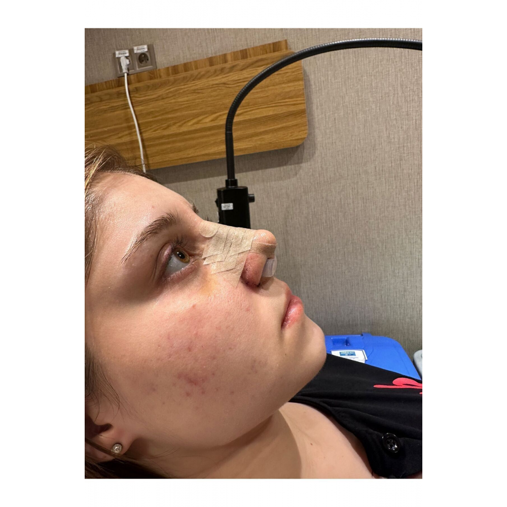 Burun Deliği Şekillendirici(1)(7)nostril Retainer