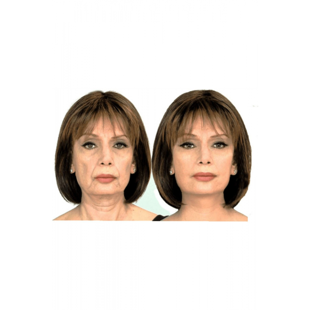 Yüz Gerdirme Bandı Kırışıklık Oluşumunu Engelleme Bandı Yüz Germe 5cm 5 Mt