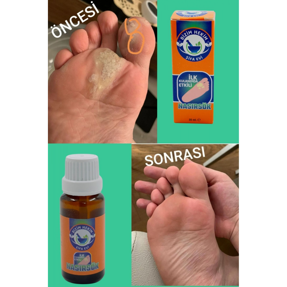 Nasırsök Nasır Sökücü Solüsyon %100 Etkili Nasır Solüsyonu