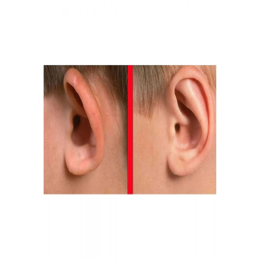 Şeffaf Çift Taraflı Kepçe Kulak Düzeltme Bandı, Kulak Bandı, Kepçekulak Bandı, Çocuk Kulak Bandı