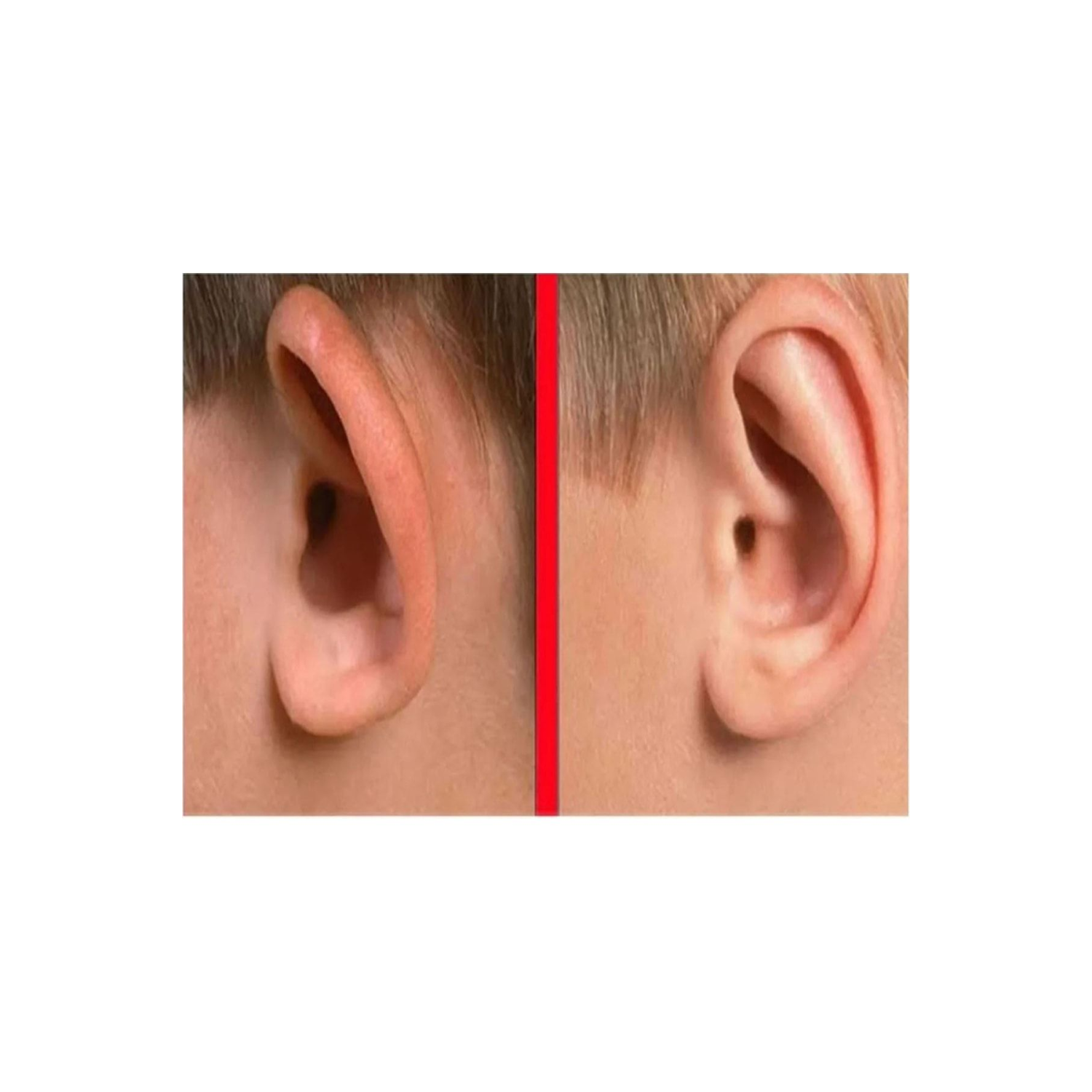 Şeffaf Çift Taraflı Kepçe Kulak Düzeltme Bandı, Kulak Bandı, Kepçekulak Bandı, Çocuk Kulak Bandı